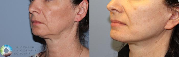 Before & After Mini Facelift Case 786 View #2 in Denver, CO