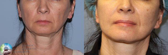 Before & After Mini Facelift Case 786 View #3 in Denver, CO