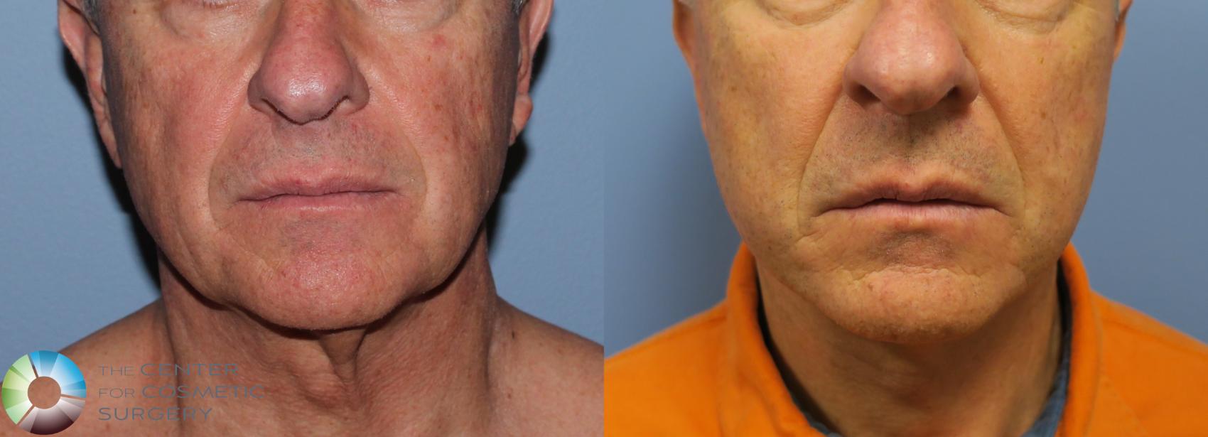 Before & After Mini Facelift Case 812 View #1 in Denver and Colorado Springs, CO