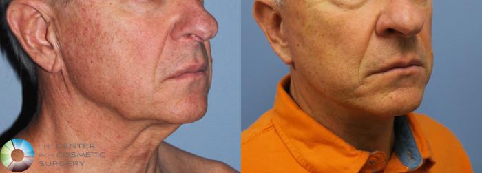 Before & After Mini Facelift Case 812 View #2 in Denver and Colorado Springs, CO