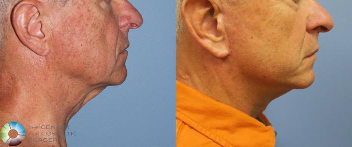 Before & After Mini Facelift Case 812 View #3 in Denver and Colorado Springs, CO