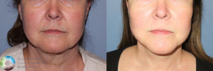 Before & After Mini Facelift Case 813 View #1 View in Golden, CO