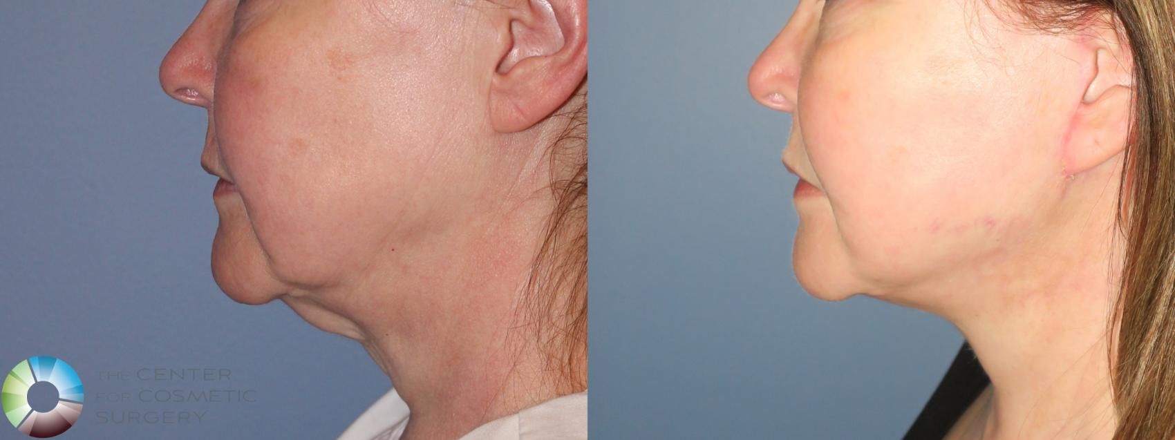 Before & After Facelift Case 813 View #3 in Denver and Colorado Springs, CO