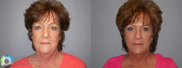 Before & After Mini Brow Lift Case 82 View #1 View in Golden, CO