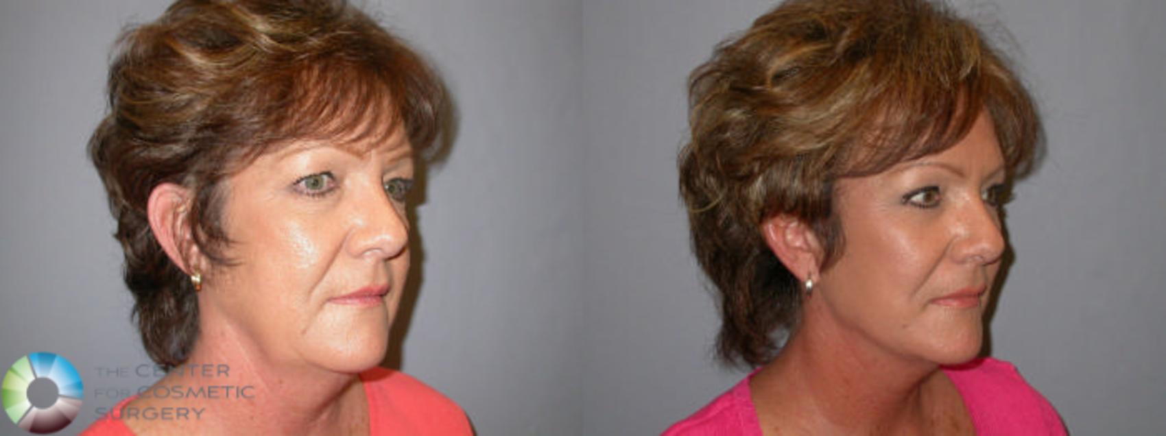 Before & After Mini Facelift Case 82 View #2 in Denver and Colorado Springs, CO