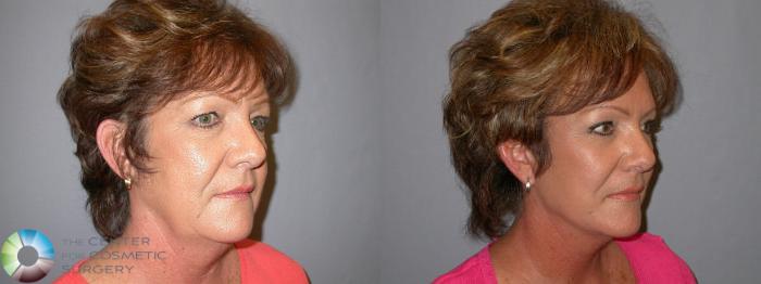 Before & After Mini Brow Lift Case 82 View #2 View in Golden, CO
