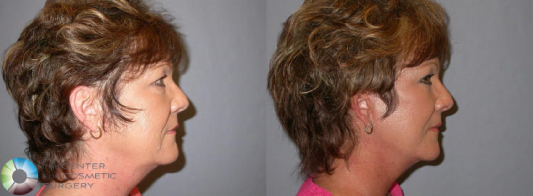 Before & After Mini Facelift Case 82 View #3 in Denver and Colorado Springs, CO