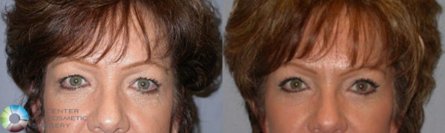 Before & After Mini Facelift Case 82 View #4 in Denver and Colorado Springs, CO
