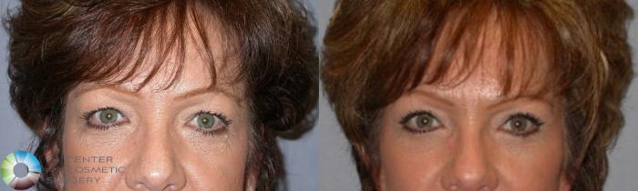 Before & After Mini Brow Lift Case 82 View #4 View in Golden, CO