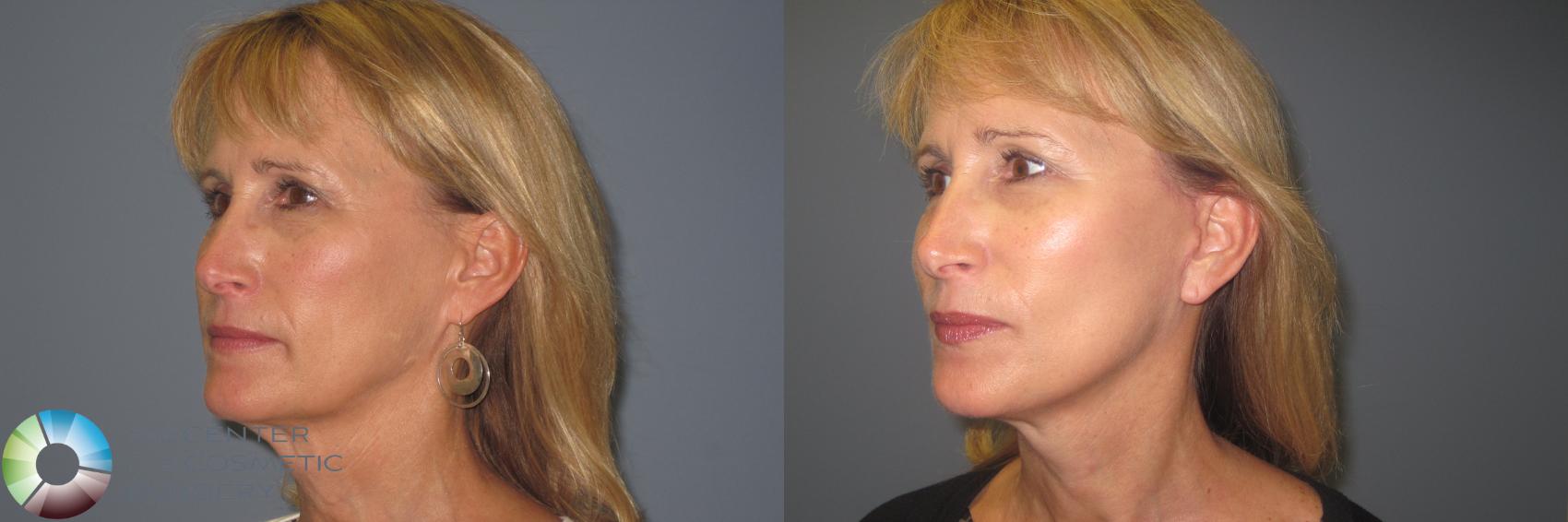 Before & After Mini Facelift Case 849 View #1 View in Denver & Golden, CO