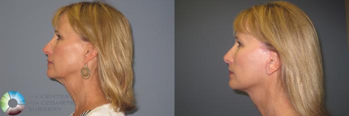 Before & After Mini Facelift Case 849 View #2 View in Golden, CO