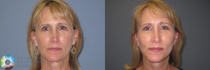 Before & After Mini Facelift Case 849 View #3 View in Golden, CO