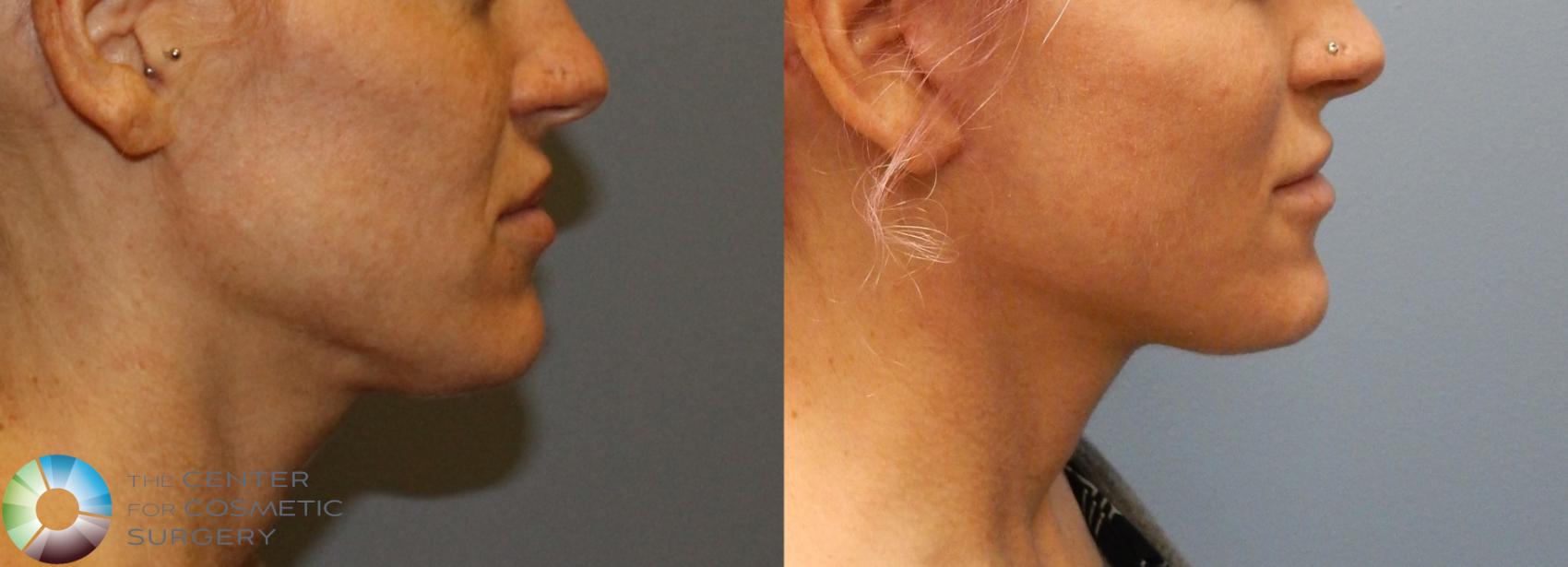 Before & After Facelift Case 852 View #1 in Denver and Colorado Springs, CO