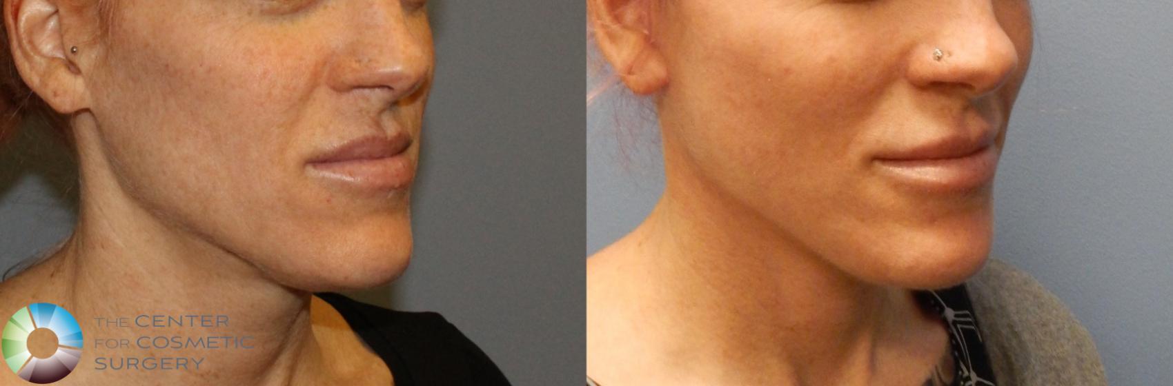 Before & After Mini Facelift Case 852 View #2 in Denver and Colorado Springs, CO
