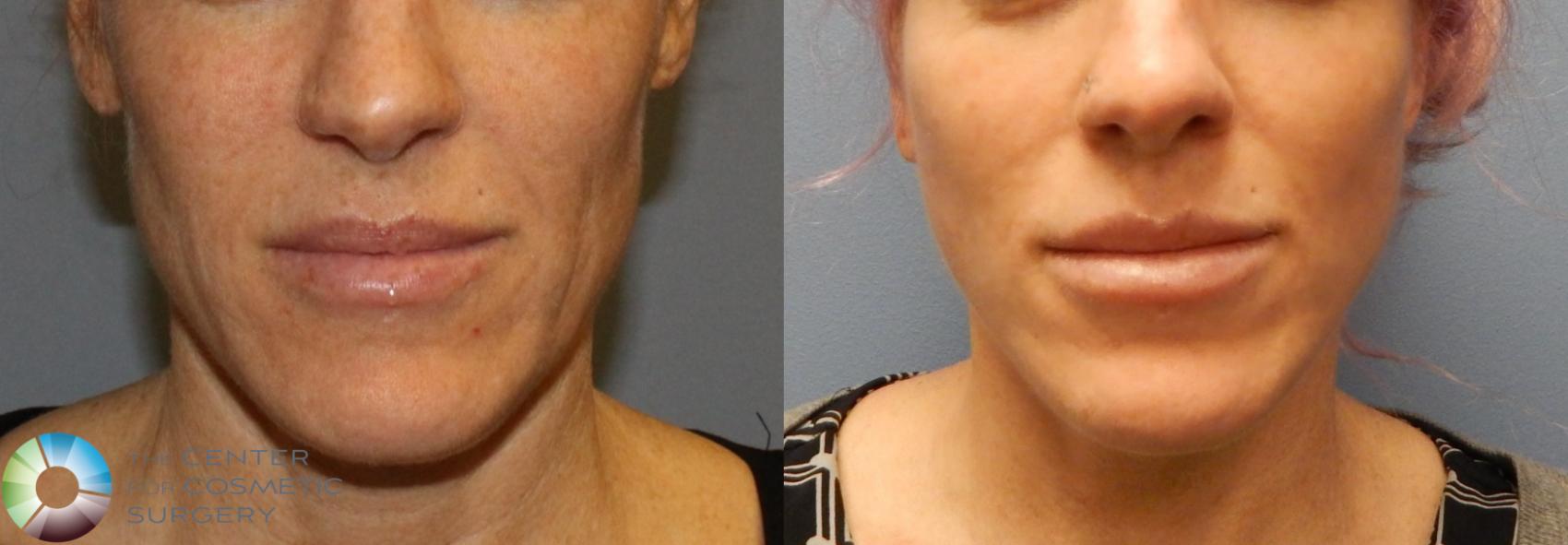 Before & After Mini Facelift Case 852 View #3 in Denver and Colorado Springs, CO