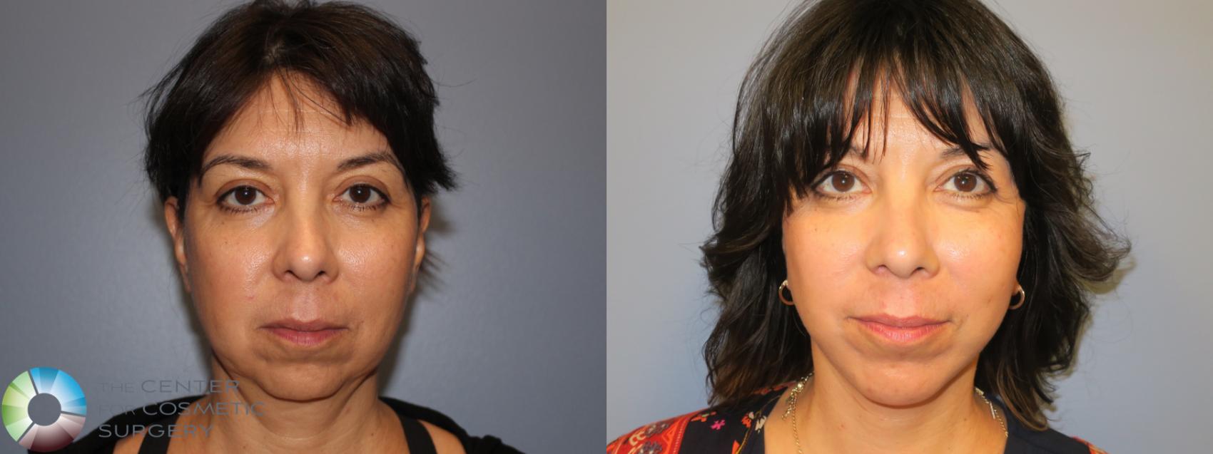 Before & After Mini Facelift Case 928 Anterior in Denver and Colorado Springs, CO