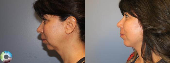 Before & After Facelift Case 928 Left lateral in Denver and Colorado Springs, CO