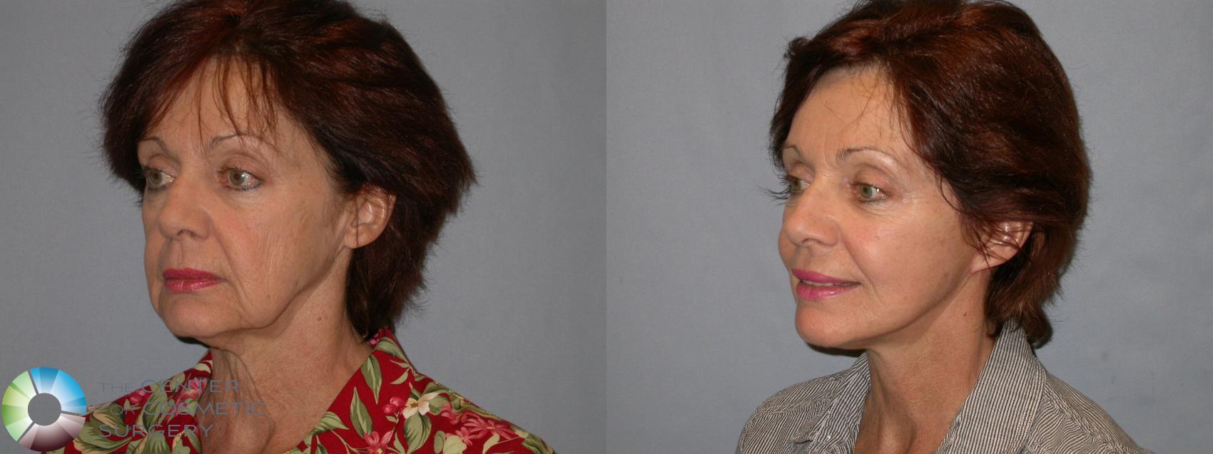 Before & After Mini Facelift Case 96 View #2 in Denver and Colorado Springs, CO