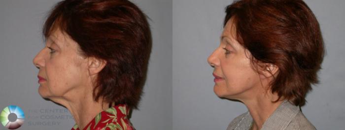 Before & After Mini Facelift Case 96 View #3 View in Golden, CO