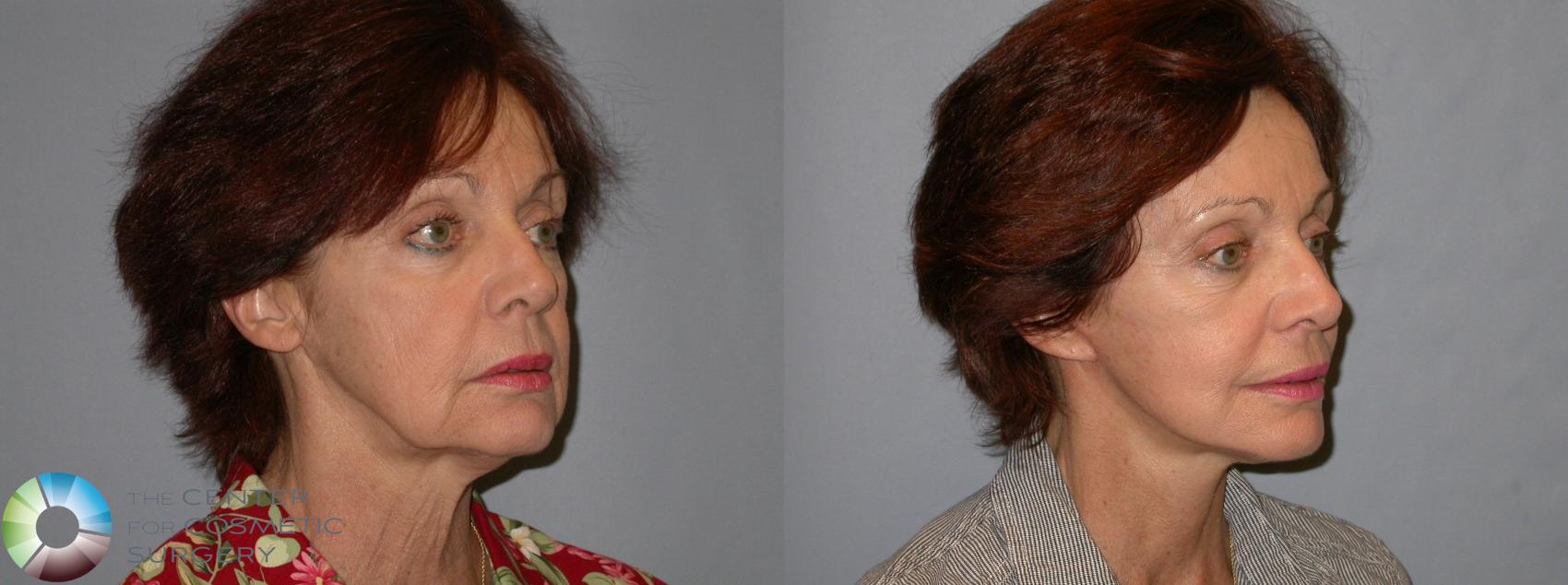 Before & After Mini Facelift Case 96 View #4 in Denver and Colorado Springs, CO