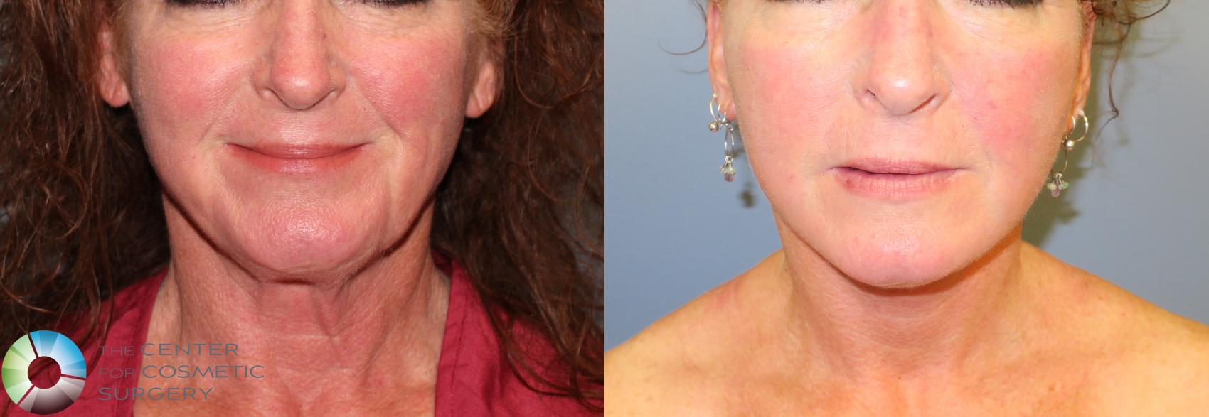 Before & After Mini Facelift Case 967 View #2 View in Golden, CO