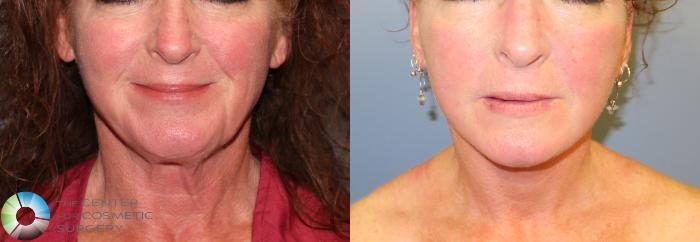 Before & After Facelift Case 967 View #2 View in Golden, CO