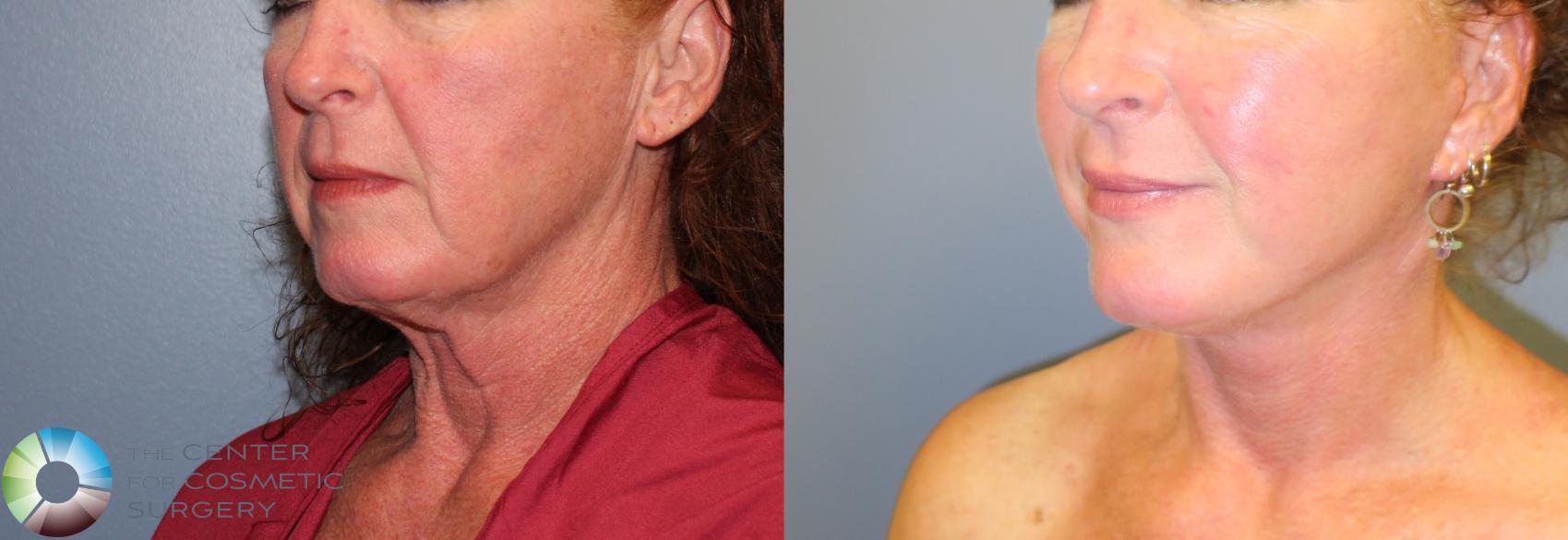 Before & After Mini Facelift Case 967 View #3 View in Golden, CO