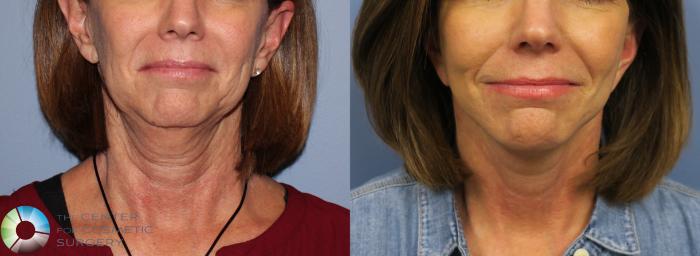 Before & After Mini Facelift Case 968 View #1 in Denver and Colorado Springs, CO