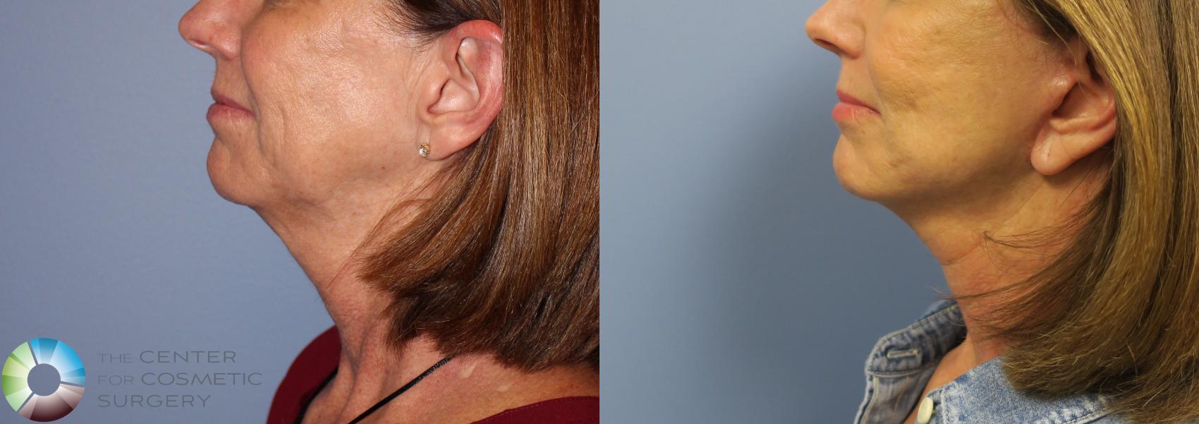 Before & After Mini Facelift Case 968 View #3 in Denver and Colorado Springs, CO