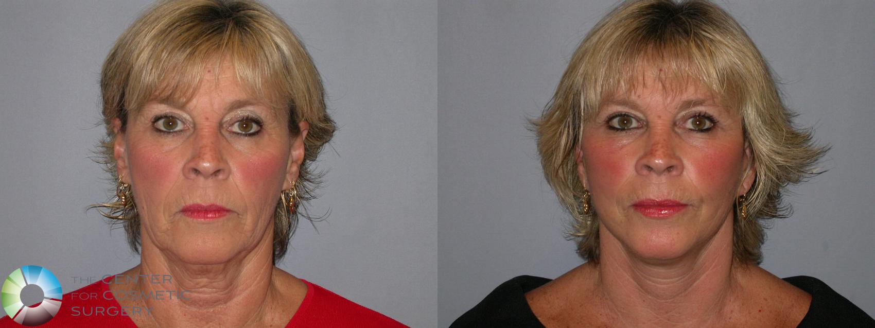 Before & After Mini Facelift Case 97 View #1 View in Golden, CO