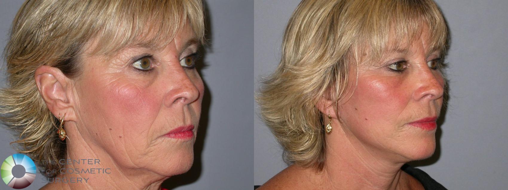 Before & After Mini Facelift Case 97 View #2 in Denver and Colorado Springs, CO