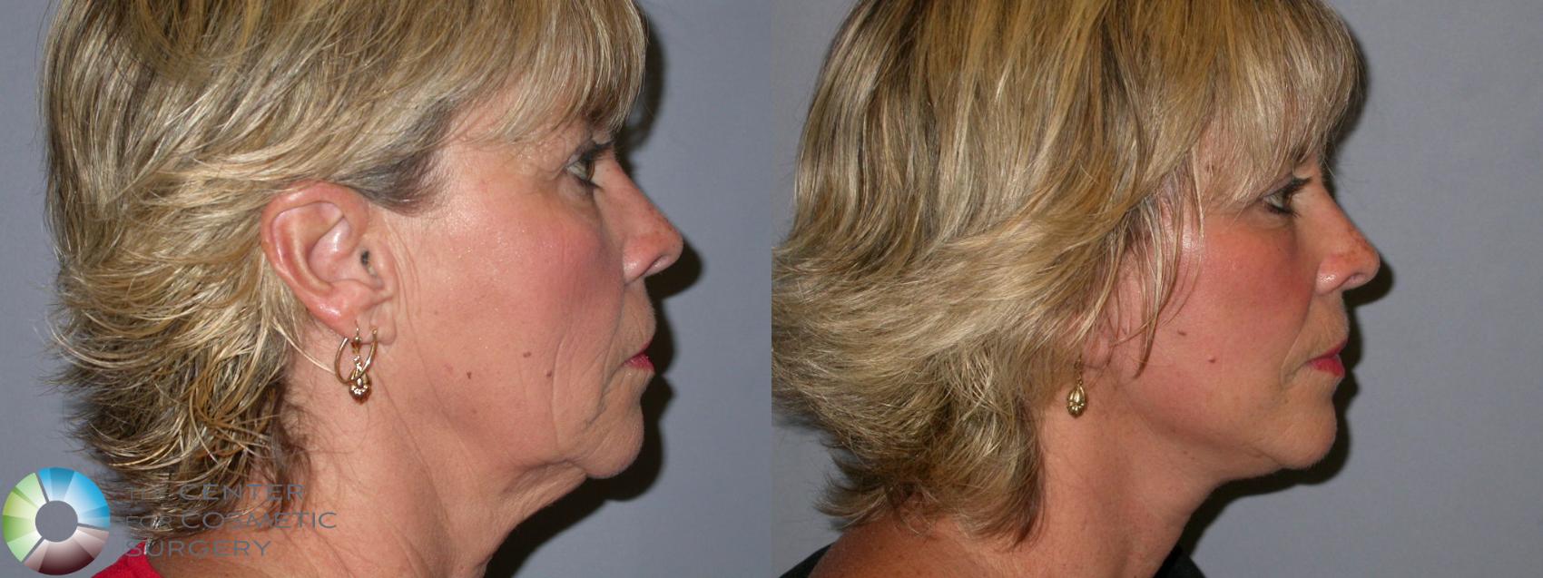 Before & After Mini Facelift Case 97 View #3 in Denver and Colorado Springs, CO
