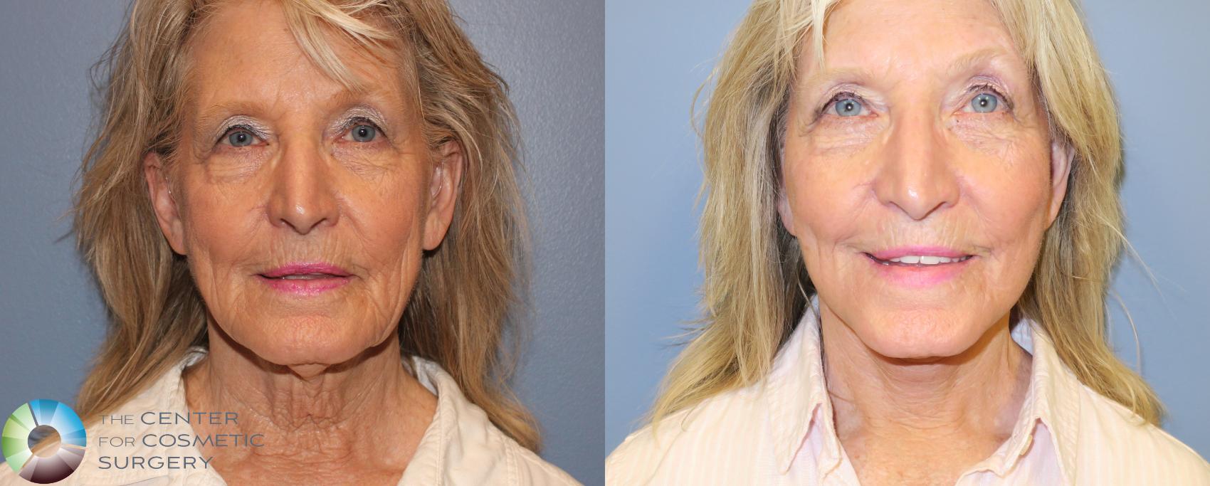 Before & After Neck Lift Case 970 View #1 View in Golden, CO
