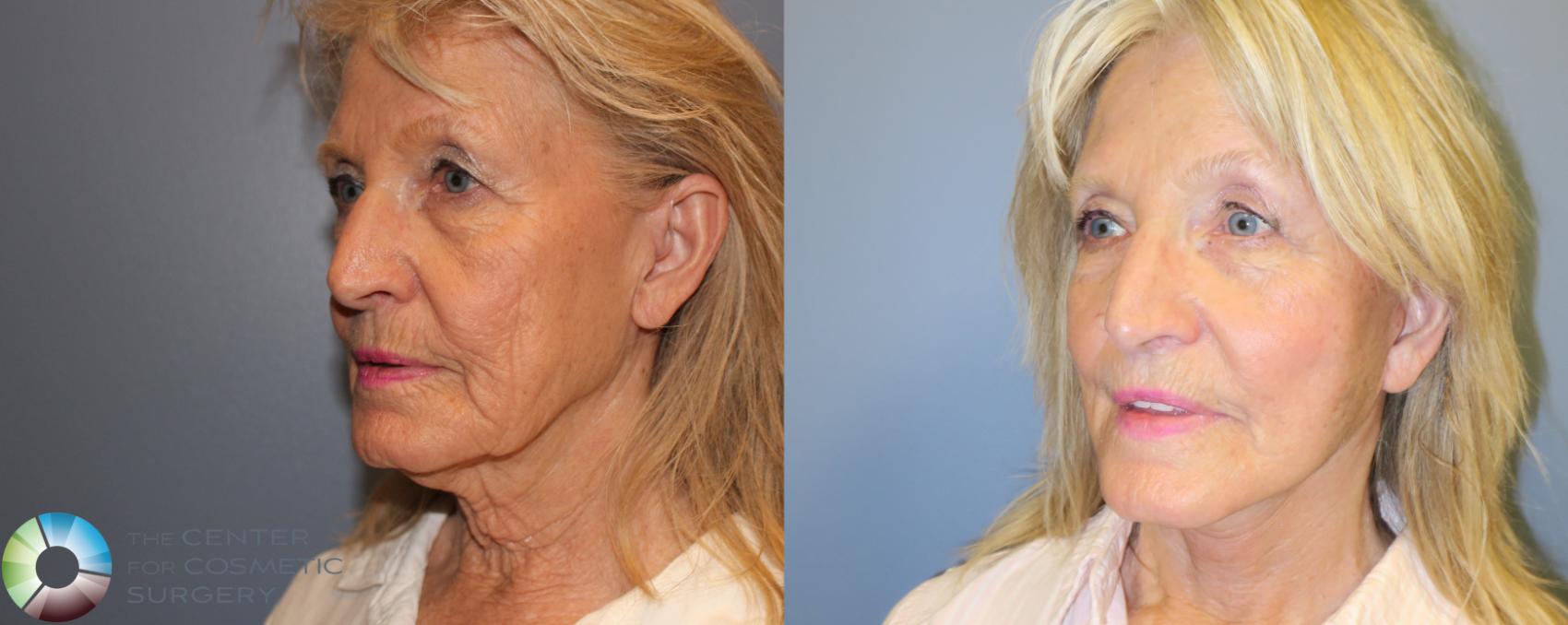 Before & After Mini Facelift Case 970 View #2 in Denver and Colorado Springs, CO