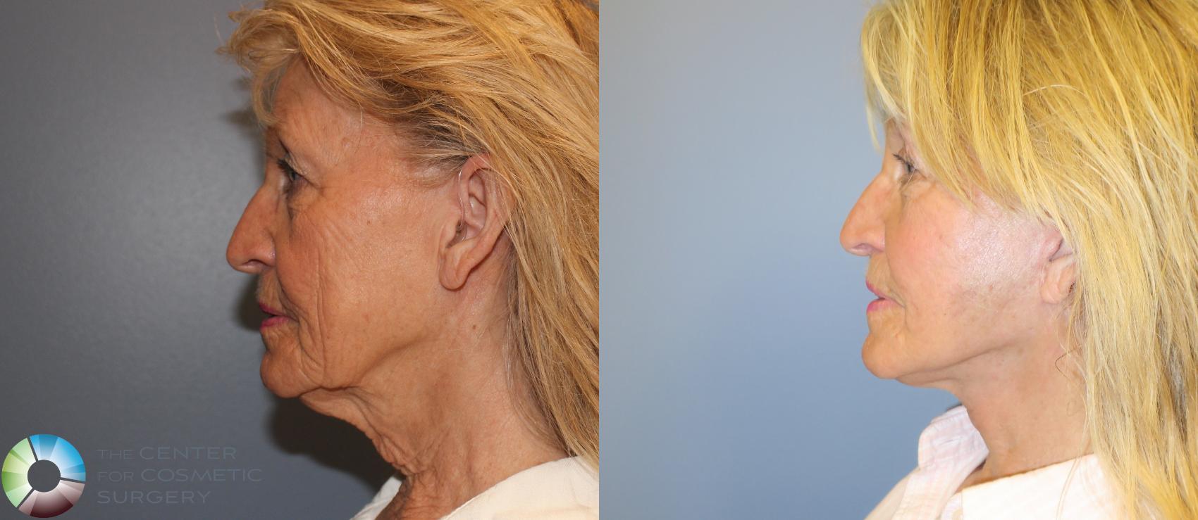 Before & After Mini Facelift Case 970 View #3 in Denver and Colorado Springs, CO