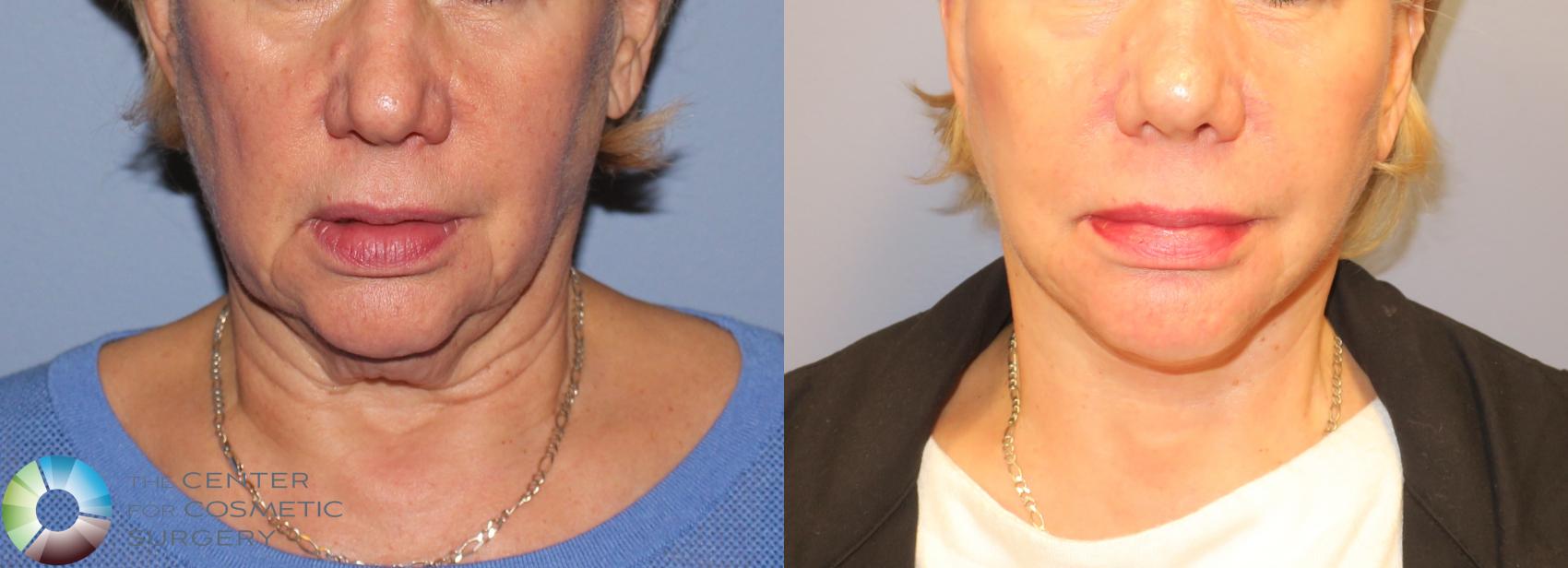 Before & After Mini Facelift Case 971 View #1 View in Golden, CO