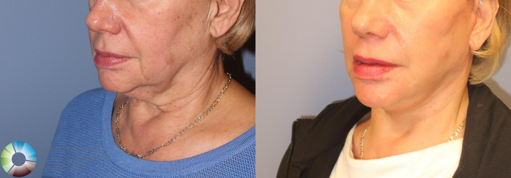 Before & After Mini Facelift Case 971 View #2 in Denver and Colorado Springs, CO