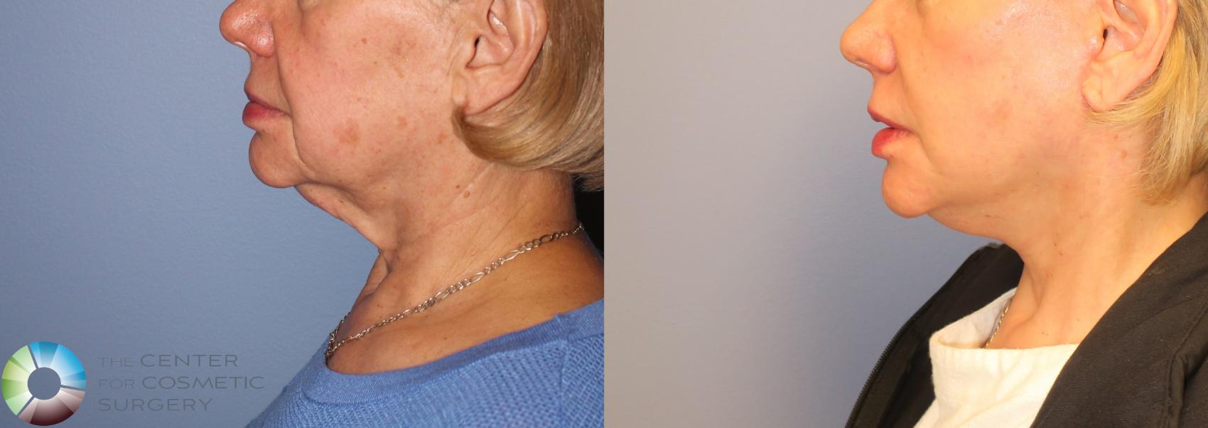 Before & After Mini Facelift Case 971 View #3 in Denver and Colorado Springs, CO