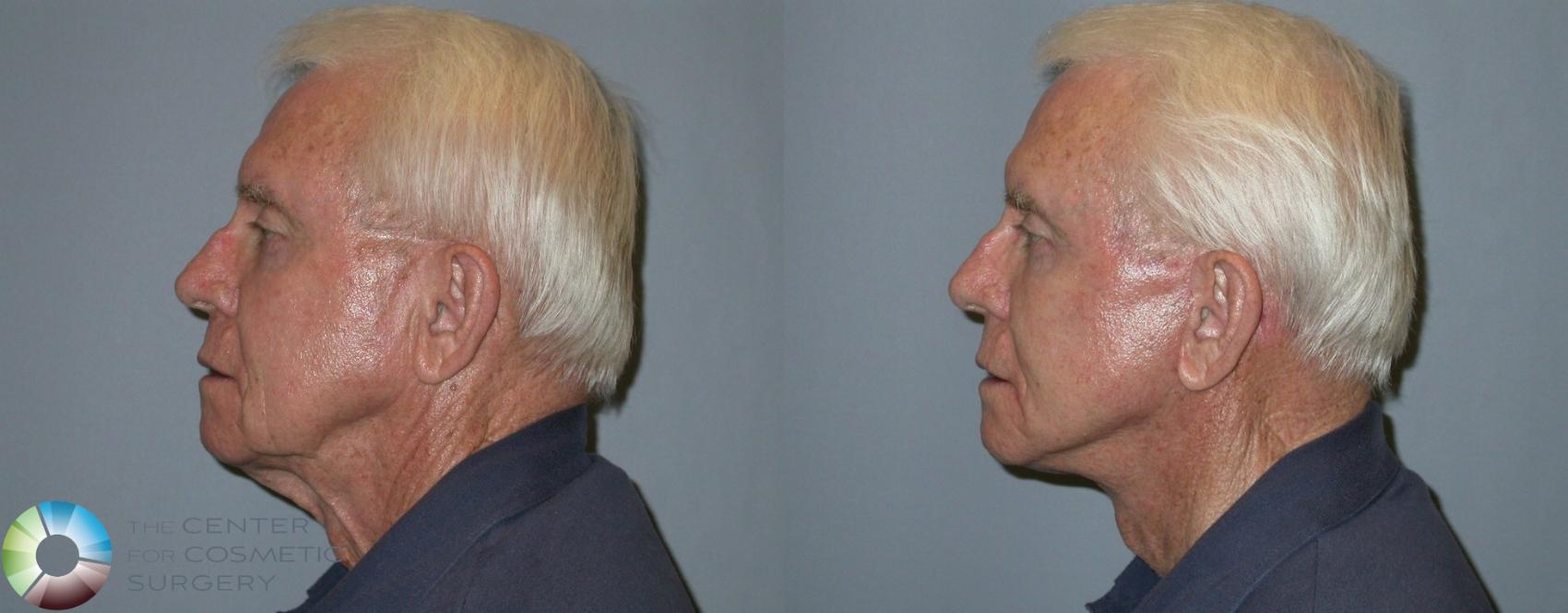 Before & After Mini Facelift Case 98 View #2 in Denver and Colorado Springs, CO