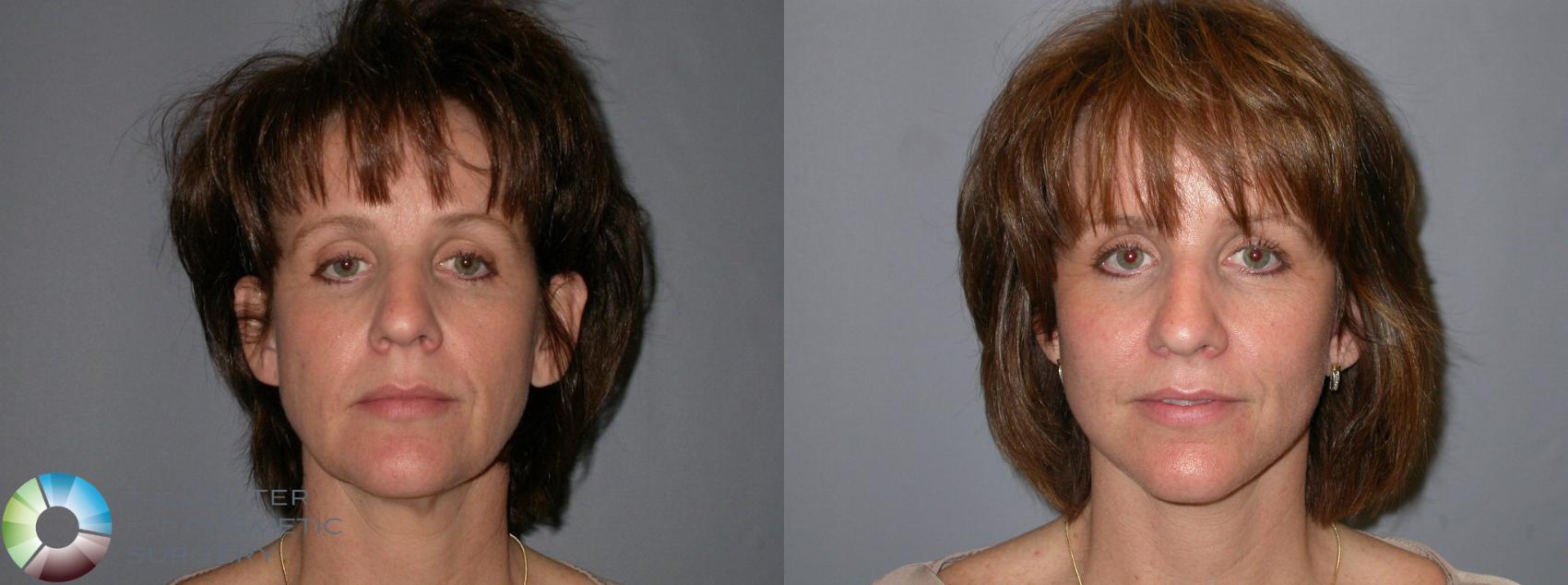 Before & After Facelift Case 99 View #1 in Denver and Colorado Springs, CO