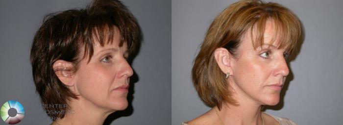 Before & After Mini Facelift Case 99 View #2 in Denver and Colorado Springs, CO