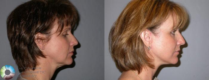 Before & After Mini Facelift Case 99 View #3 in Denver and Colorado Springs, CO