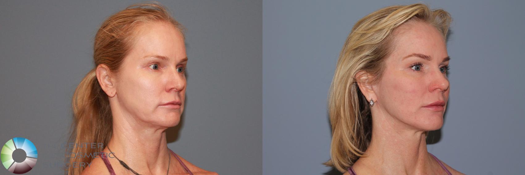 Before & After Mini Facelift Case 990 View #1 in Denver and Colorado Springs, CO