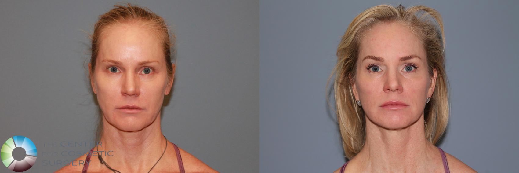 Before & After Mini Facelift Case 990 View #2 in Denver and Colorado Springs, CO
