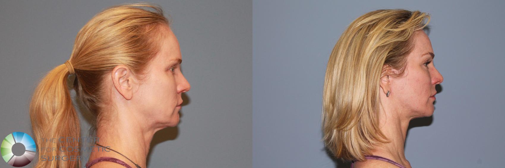 Before & After Mini Facelift Case 990 View #3 in Denver and Colorado Springs, CO
