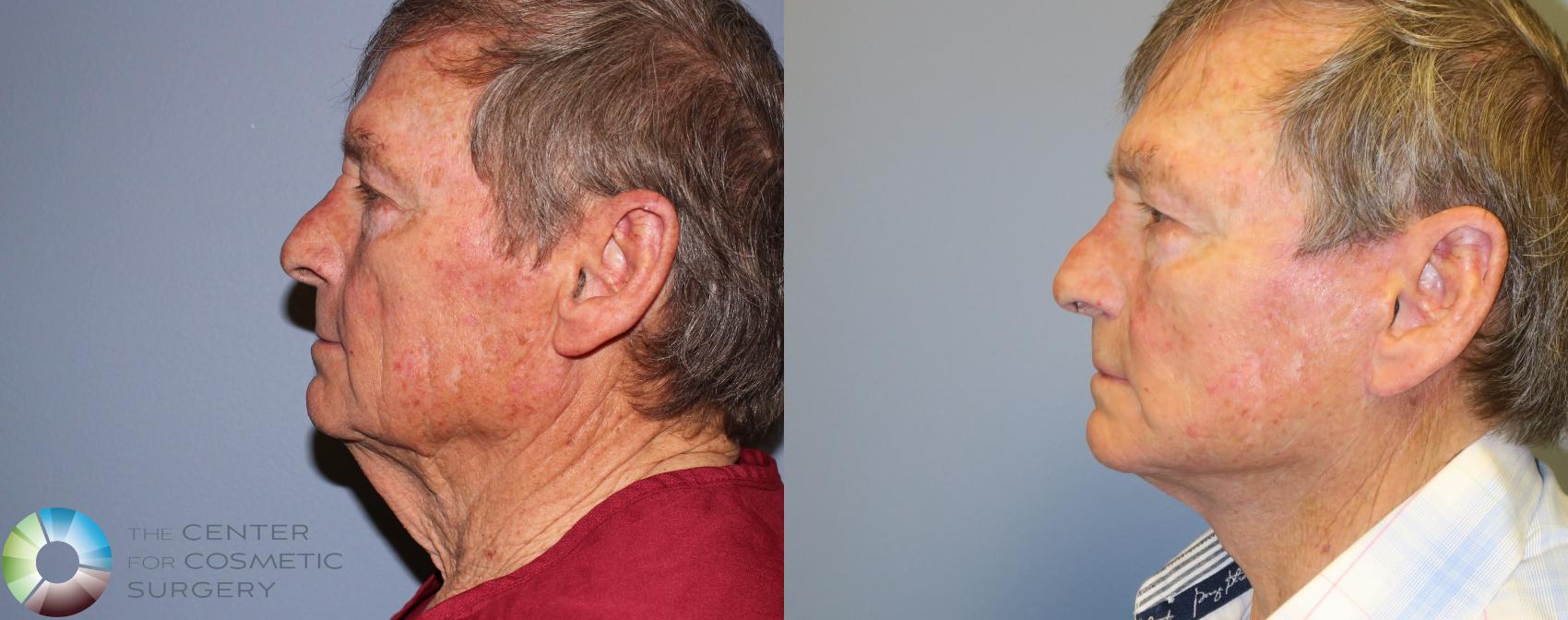 Before & After Neck Lift Case 993 View #1 View in Denver & Golden, CO