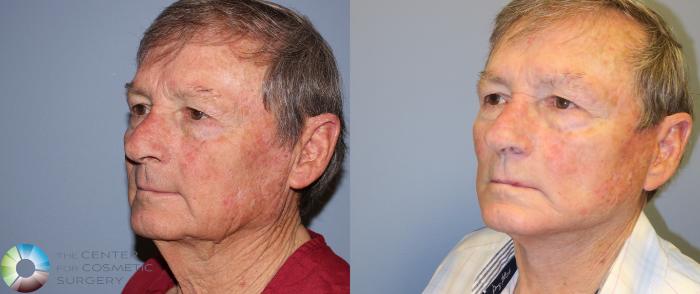 Before & After Facelift Case 993 View #2 View in Golden, CO