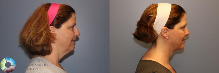 Before & After Mini Facelift Case 998 View #1 in Denver and Colorado Springs, CO