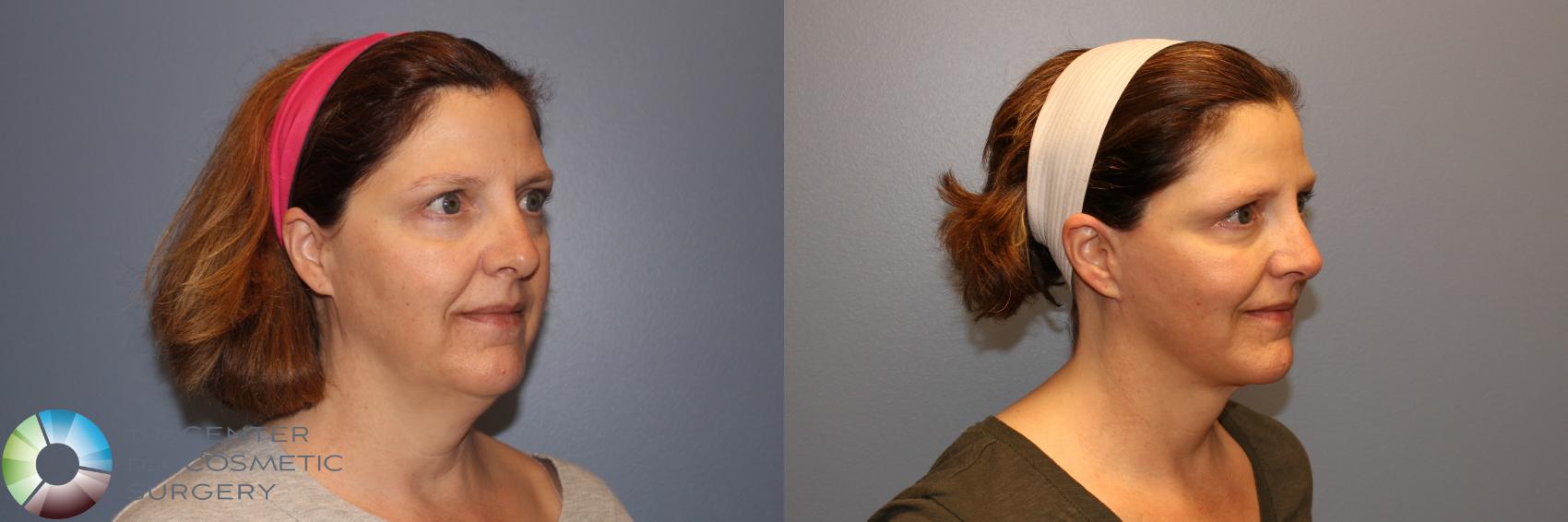 Before & After Mini Facelift Case 998 View #2 in Denver and Colorado Springs, CO