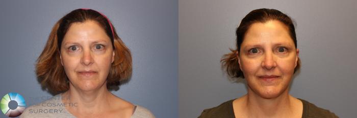 Before & After Mini Facelift Case 998 View #3 in Denver and Colorado Springs, CO